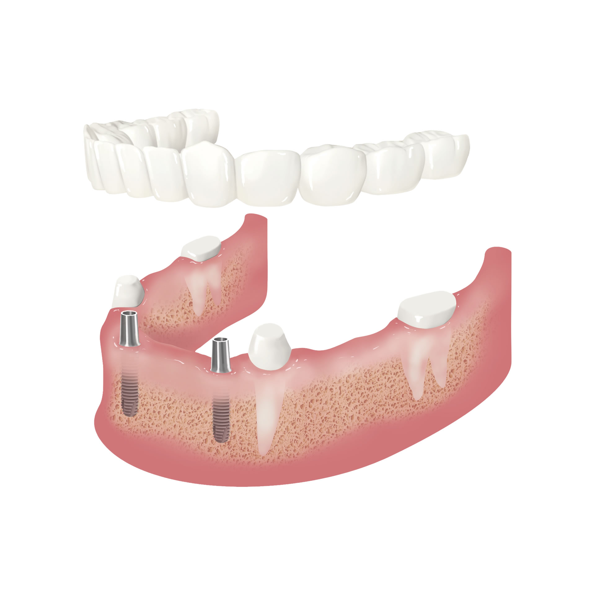 Implantatversorgung Beispiel 3