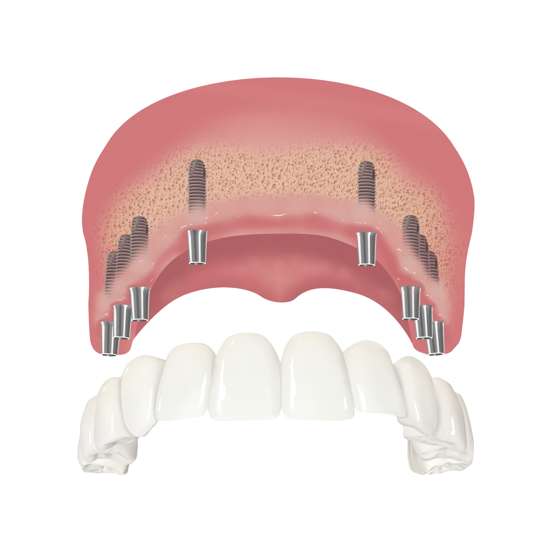 Implantatversorgung Beispiel 4