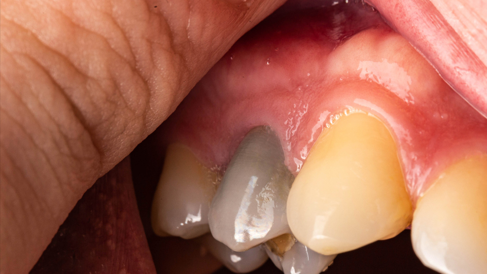 Ein „toter“ Zahn – Was sind die Optionen bei „Zahnsterben“?