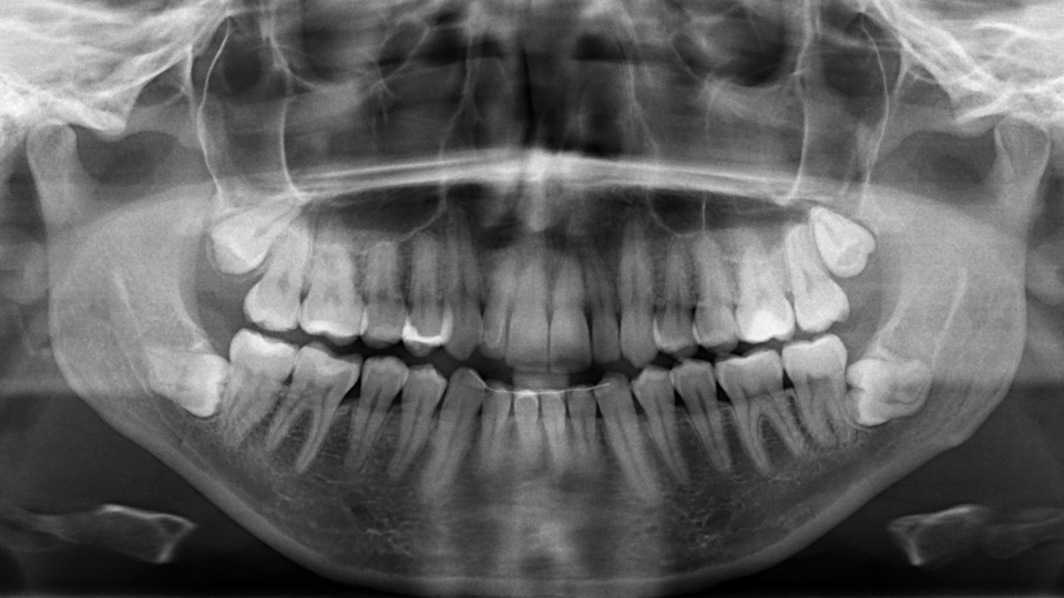 Auf Röntgenbildern lassen sich mögliche Komplikationen durch nachrückende Weißheitszähne meist frühzeitig erkennen.