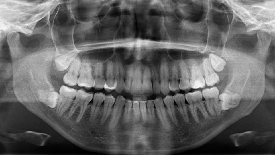 Wissenswertes zum Weisheitszahn: Probleme durch Wachstum 