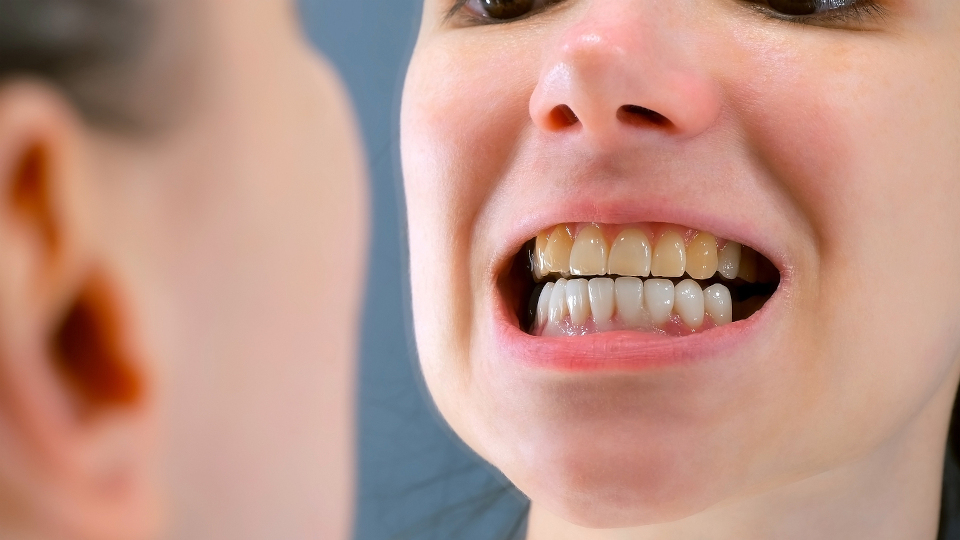 Verfärbungen an den Zähnen: Was sind die Auslöser?