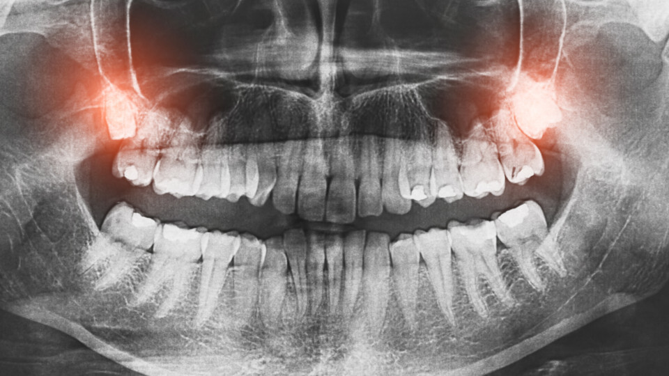 Eine Röntgenaufnahme des Gebisses mit Weisheitszähnen