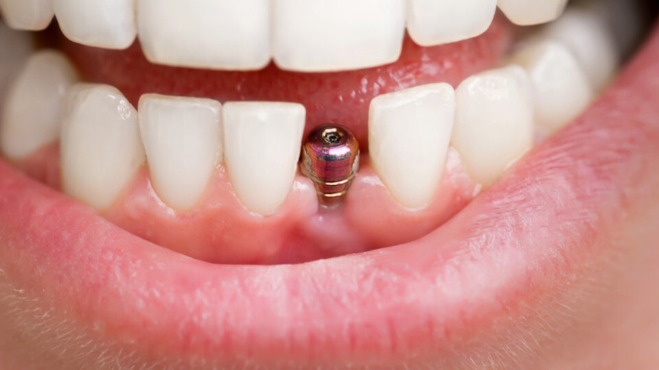 Ein Gebiss mit einem eingeschraubten Implantat aus Titan