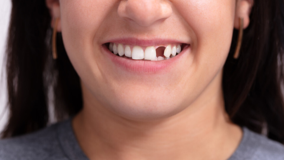 Eine Frau nach einem Zahnunfall