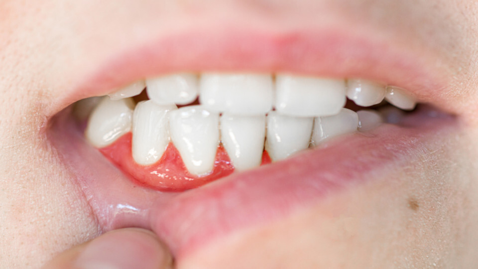 Close-up eines Mundes und Gebisses mit Zahnfleischrückgang