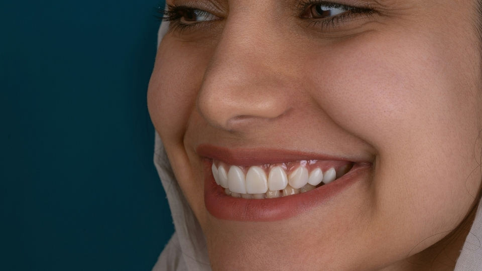 Close up einer Frau mit schönem Lächeln dank Digital Smile Design